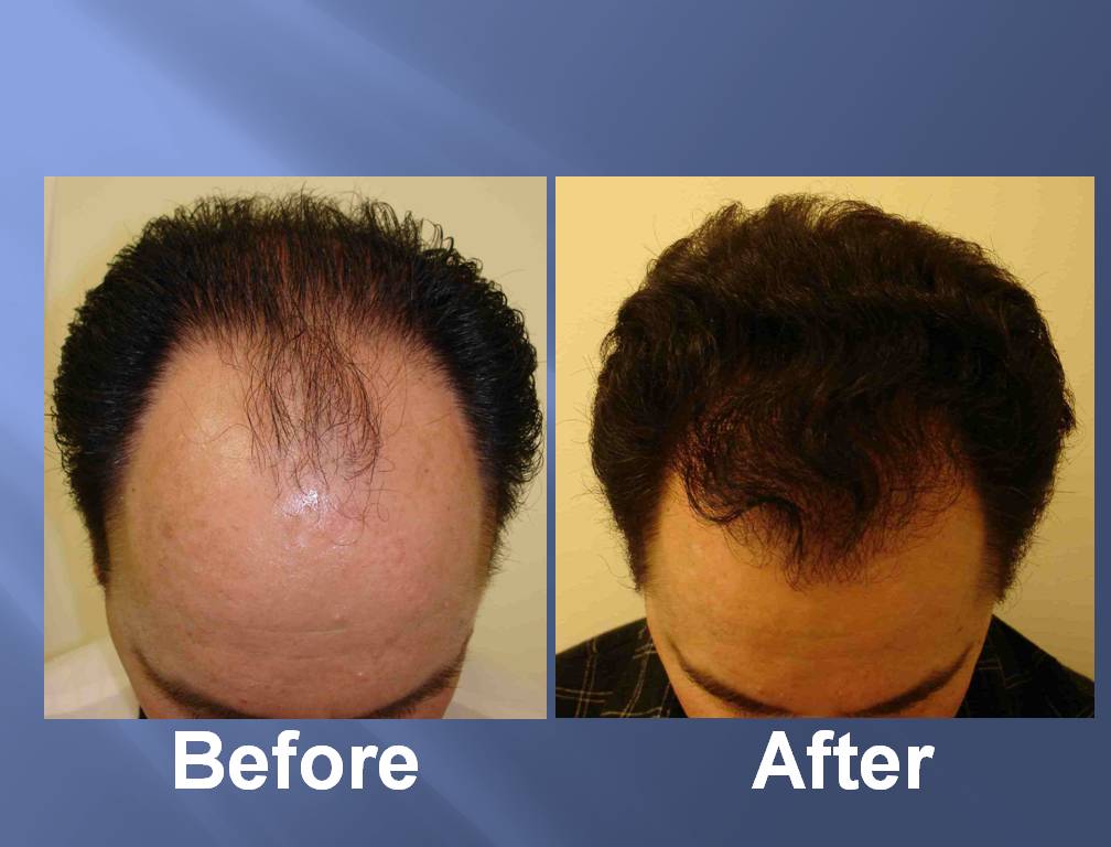 Hair Transplant Before and After pictures