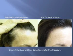 Hair Transplant Before and After Picture