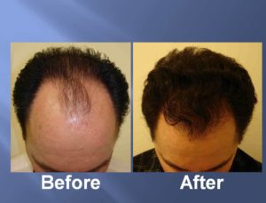 Hair Transplant Before and After Picture