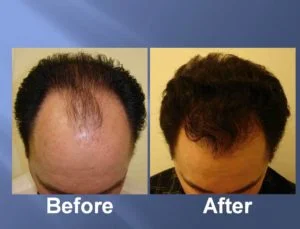 Hair Transplant Before and After Picture