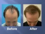 Hair Transplant Before and After Picture