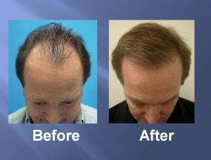 Hair Transplant Before and After Picture