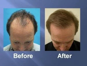 Hair Transplant Before and After Picture
