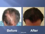 Hair Transplant Before and After Picture