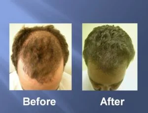 Hair Transplant Before and After Picture