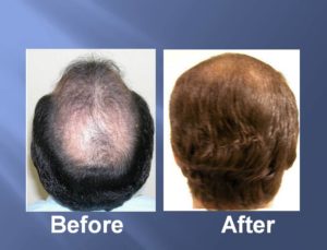 Hair Transplant Before and After Picture