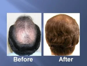 Hair Transplant Before and After Picture