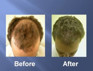 Hair Transplant Before and After Picture