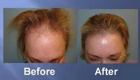 successful hair transplant before and after pics