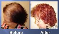 successful hair transplant before and after pics