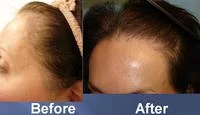 successful hair transplant before and after pics
