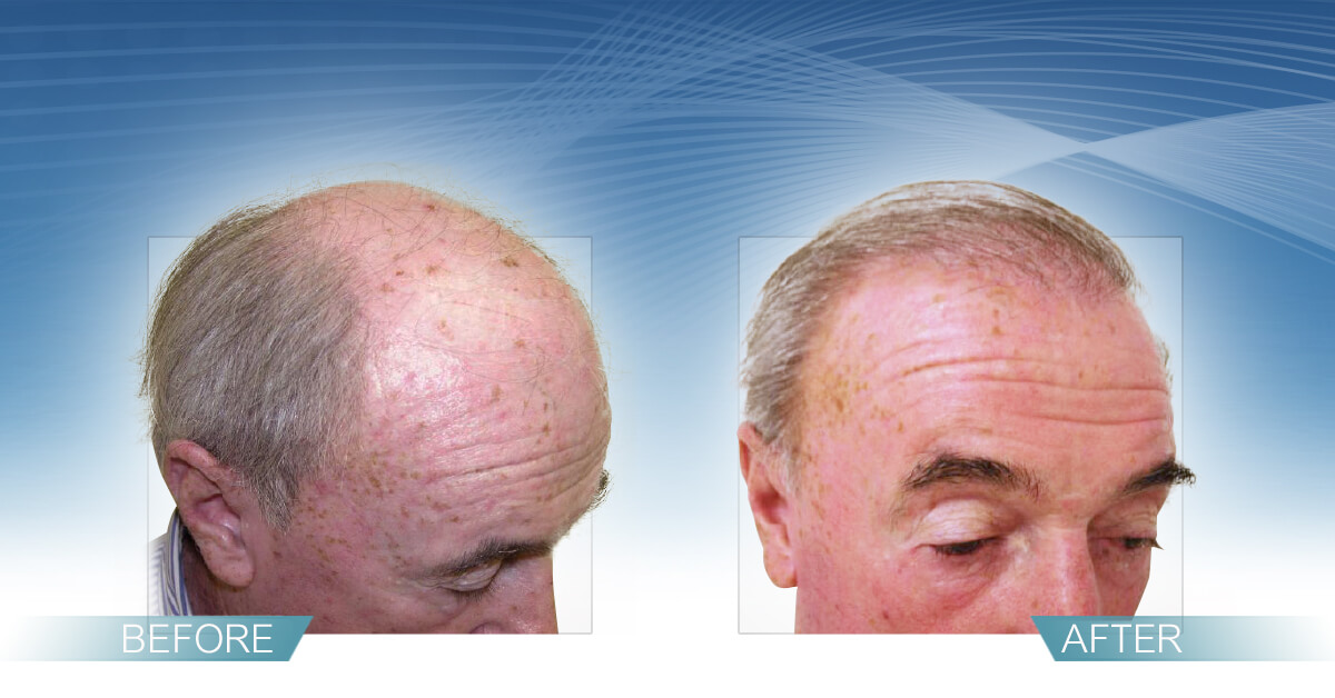 Home Hair Transplant Jupiter, FL Hair Restoration Palm Beach