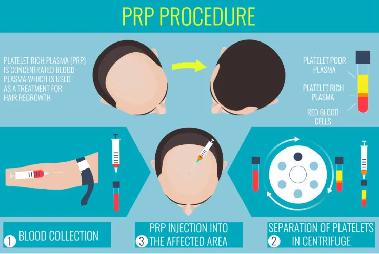 PRP-Platelet- rich- plasma
