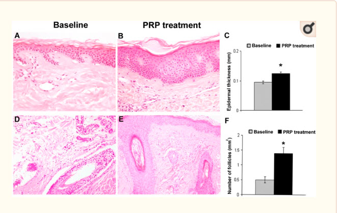 prp-treatment